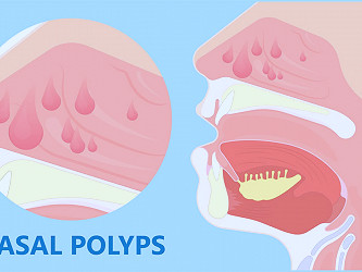 Do You Suffer from Chronic Sinusitis? You May Have Nasal Polyps -  BergerHenry ENT Specialty Group